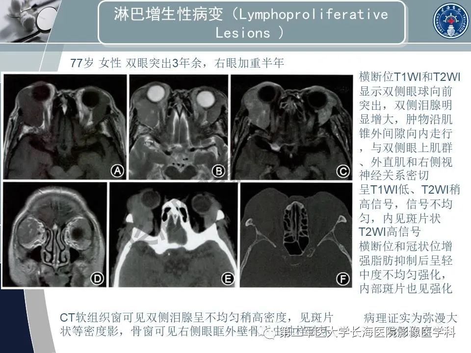 影像PPT - 【PPT】眼眶内肿瘤的影像诊断-51