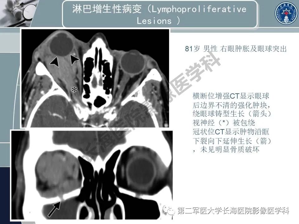 影像PPT - 【PPT】眼眶内肿瘤的影像诊断-52