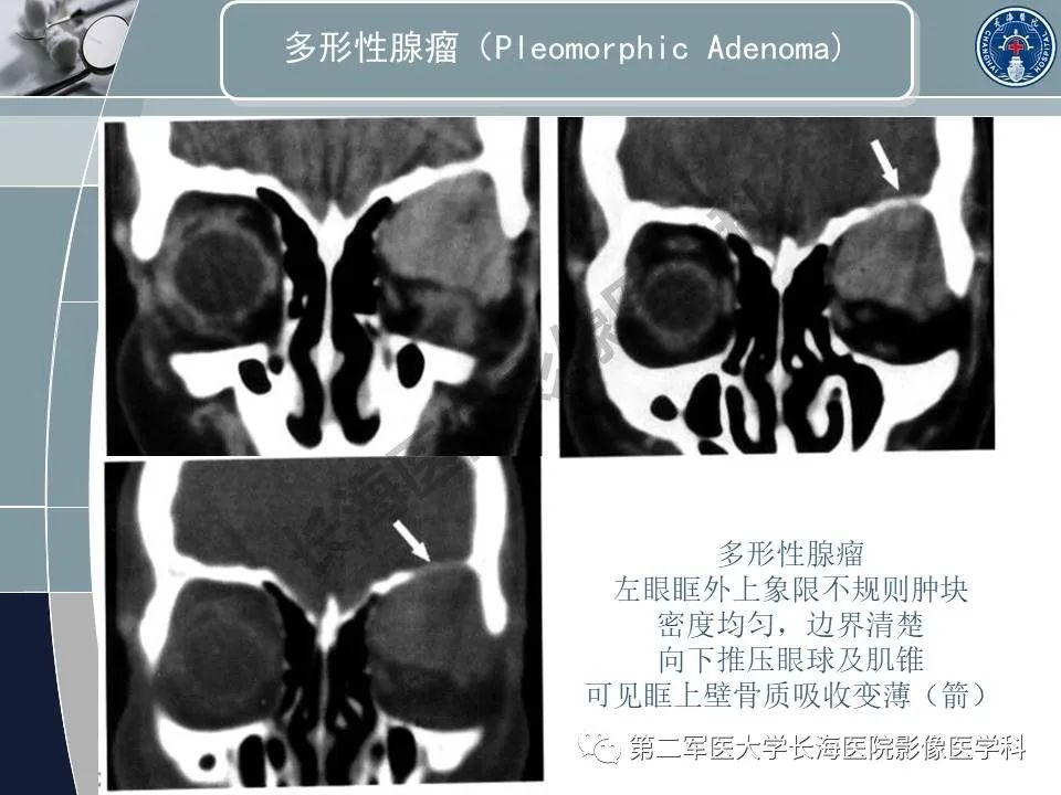 影像PPT - 【PPT】眼眶内肿瘤的影像诊断-57