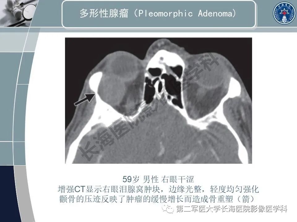 影像PPT - 【PPT】眼眶内肿瘤的影像诊断-58