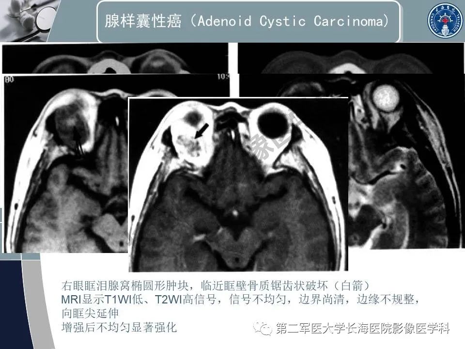影像PPT - 【PPT】眼眶内肿瘤的影像诊断-62