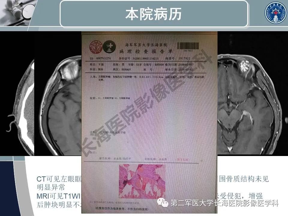 影像PPT - 【PPT】眼眶内肿瘤的影像诊断-63