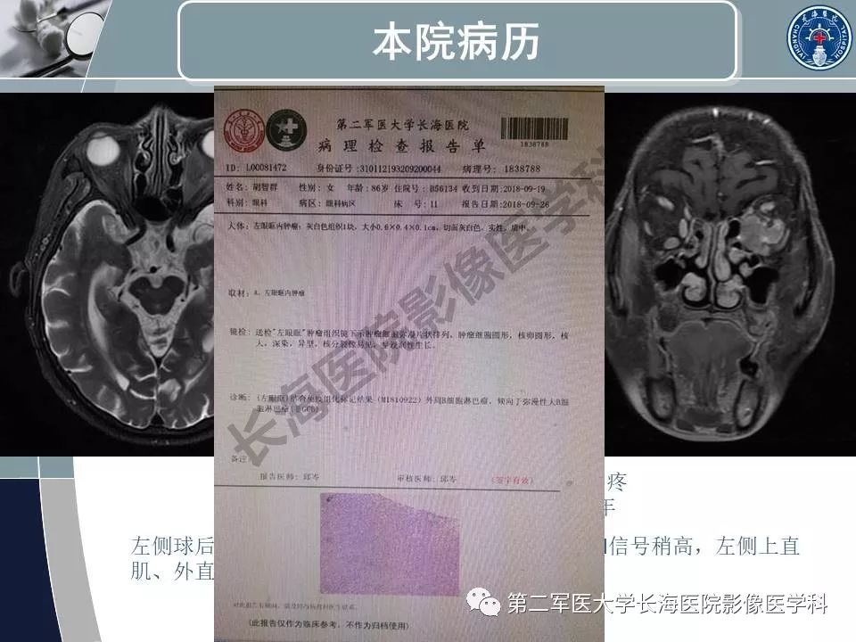 影像PPT - 【PPT】眼眶内肿瘤的影像诊断-66
