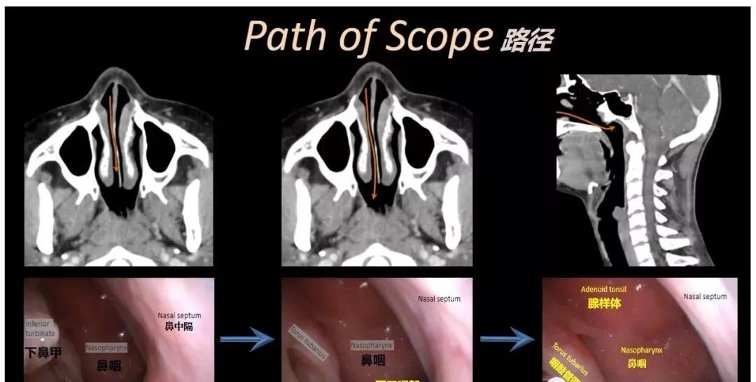 影像PPT - 【PPT】内窥镜对照的咽喉CT解剖学研究-5