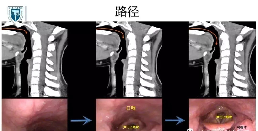 影像PPT - 【PPT】内窥镜对照的咽喉CT解剖学研究-6