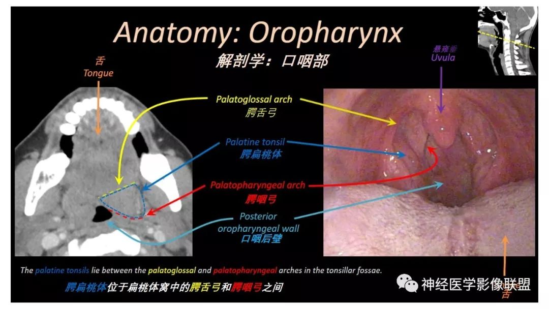 影像PPT - 【PPT】内窥镜对照的咽喉CT解剖学研究-11
