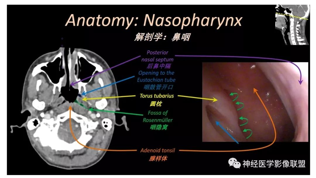 影像PPT - 【PPT】内窥镜对照的咽喉CT解剖学研究-12