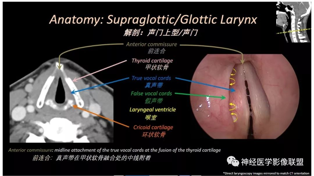 影像PPT - 【PPT】内窥镜对照的咽喉CT解剖学研究-16