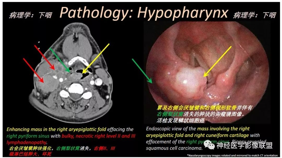 影像PPT - 【PPT】内窥镜对照的咽喉CT解剖学研究-22