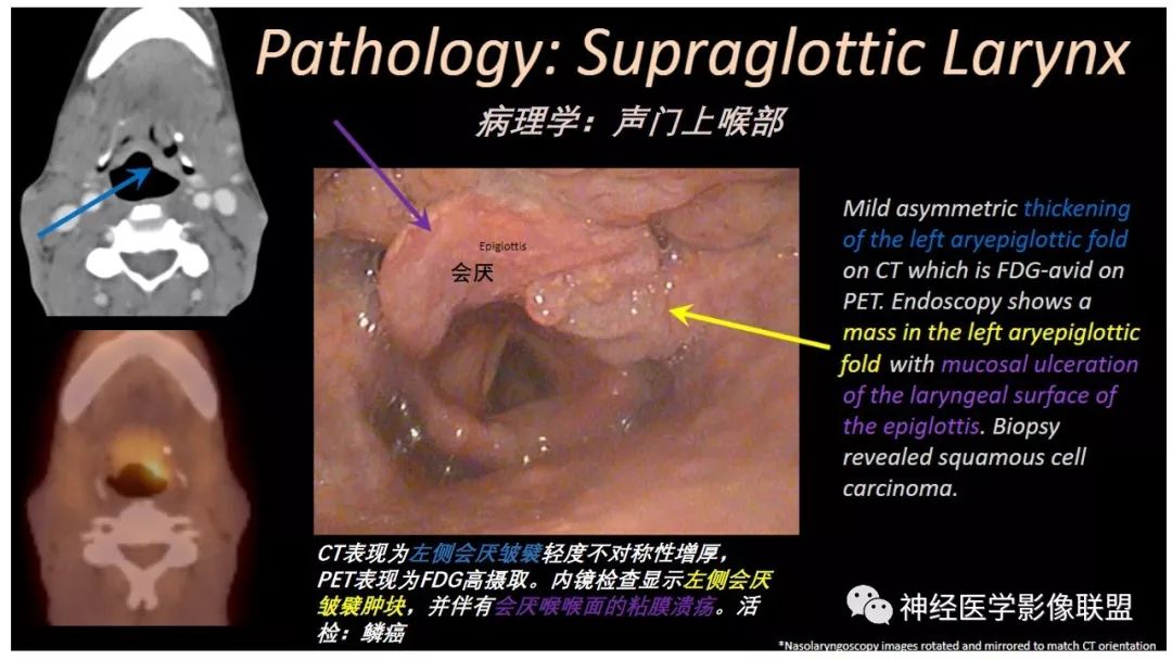 影像PPT - 【PPT】内窥镜对照的咽喉CT解剖学研究-26