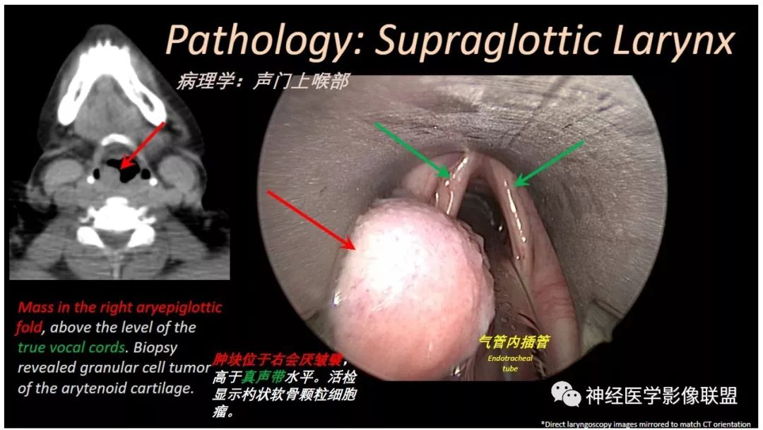 影像PPT - 【PPT】内窥镜对照的咽喉CT解剖学研究-28