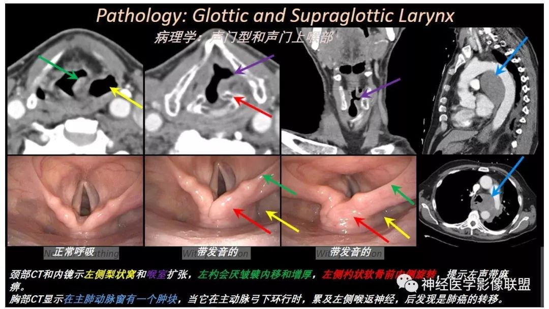 影像PPT - 【PPT】内窥镜对照的咽喉CT解剖学研究-29