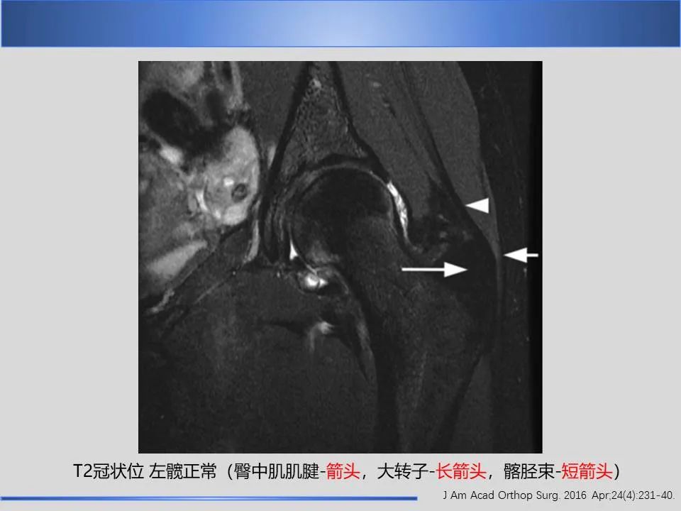 影像PPT - 【PPT】股骨大转子疼痛综合征MR特征-14