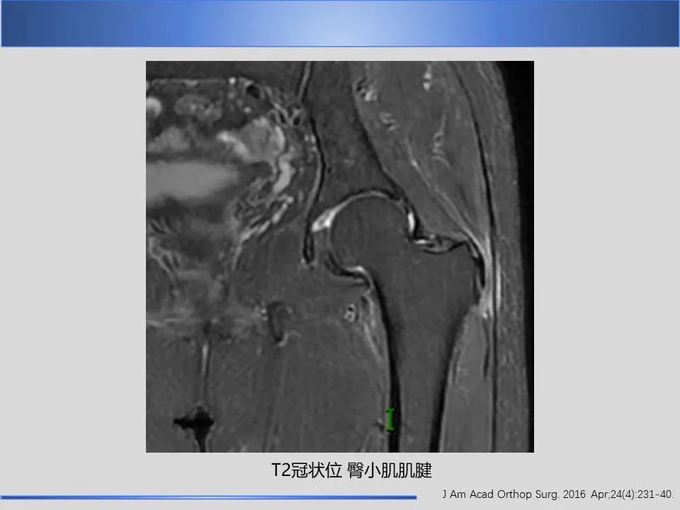 影像PPT - 【PPT】股骨大转子疼痛综合征MR特征-15