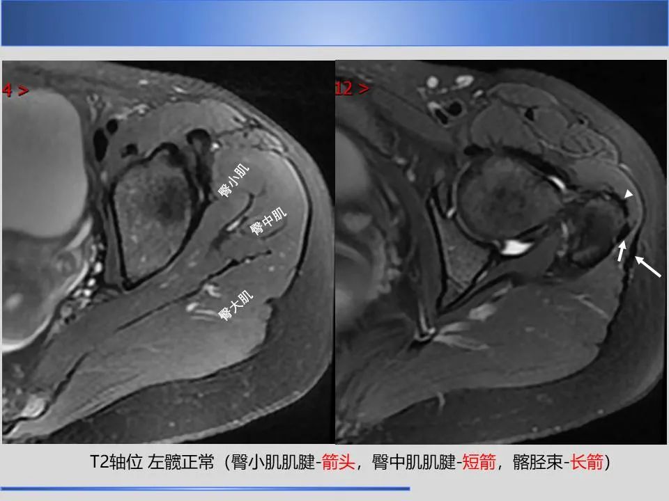 影像PPT - 【PPT】股骨大转子疼痛综合征MR特征-16