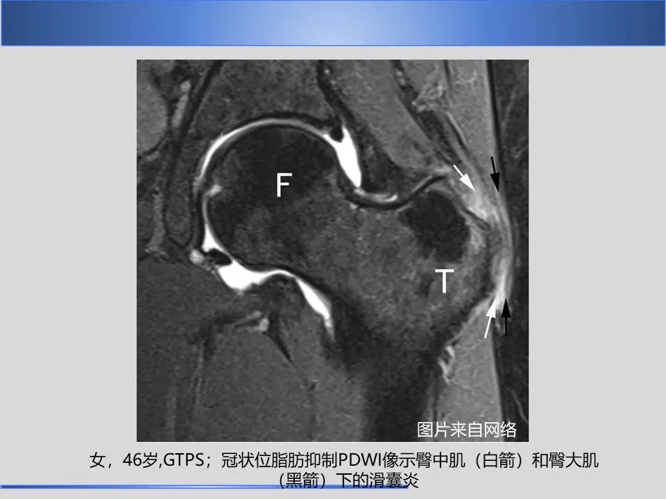 影像PPT - 【PPT】股骨大转子疼痛综合征MR特征-17