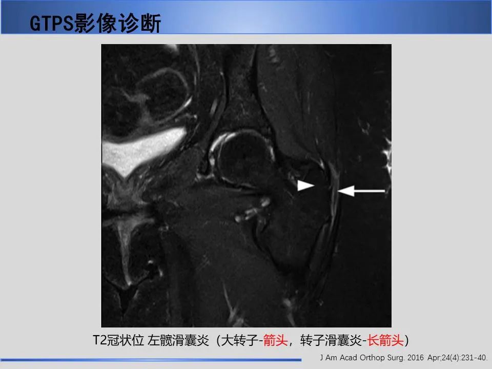 影像PPT - 【PPT】股骨大转子疼痛综合征MR特征-18