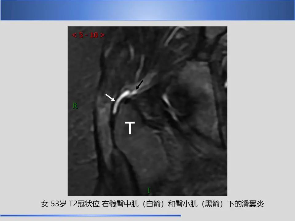 影像PPT - 【PPT】股骨大转子疼痛综合征MR特征-19