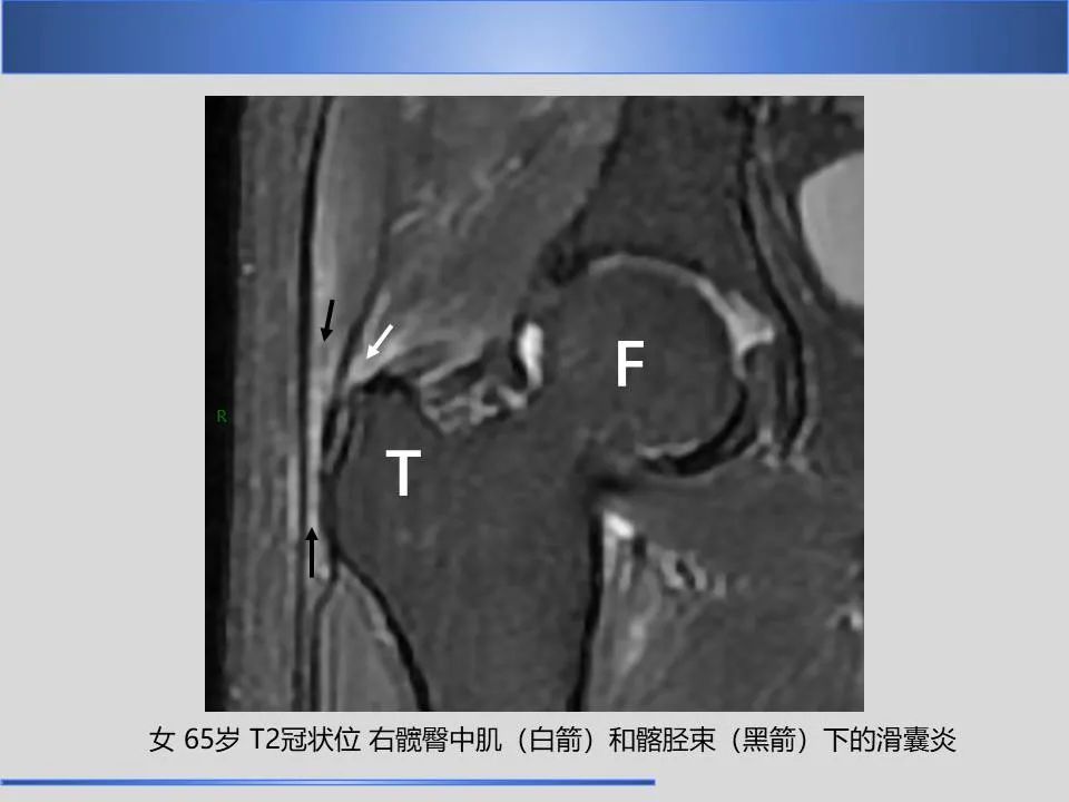 影像PPT - 【PPT】股骨大转子疼痛综合征MR特征-20