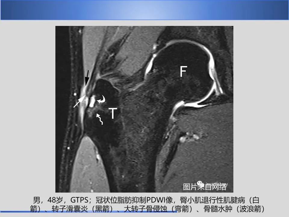 影像PPT - 【PPT】股骨大转子疼痛综合征MR特征-21