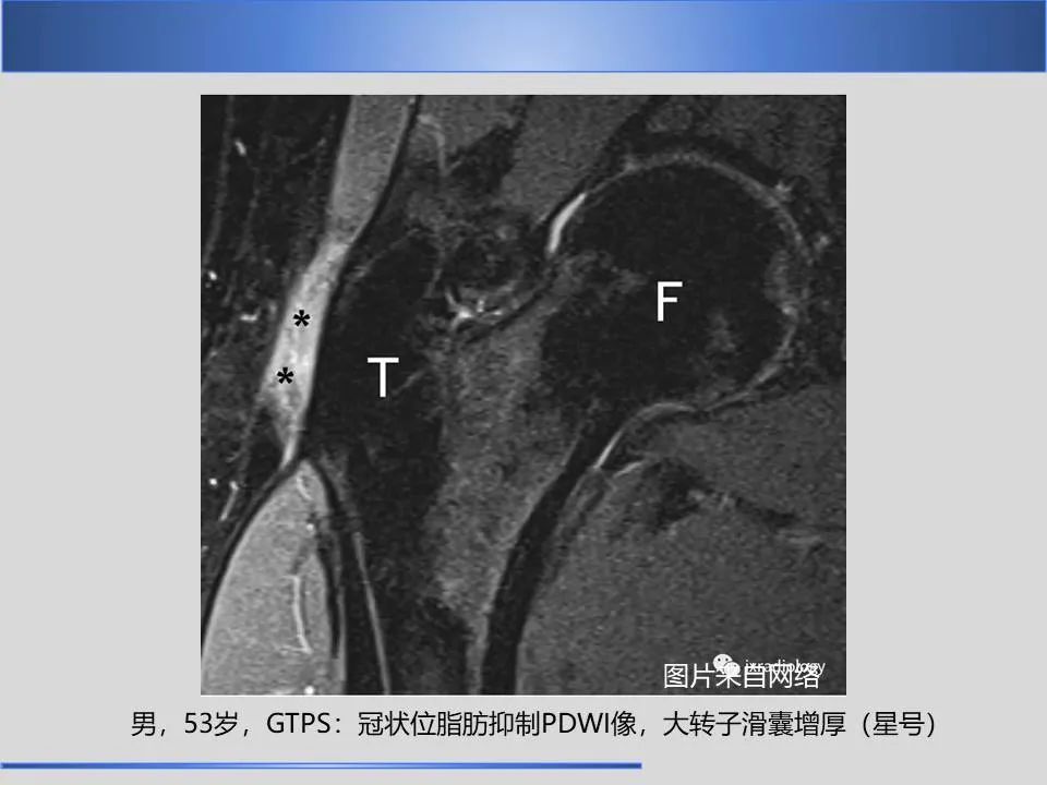 影像PPT - 【PPT】股骨大转子疼痛综合征MR特征-22