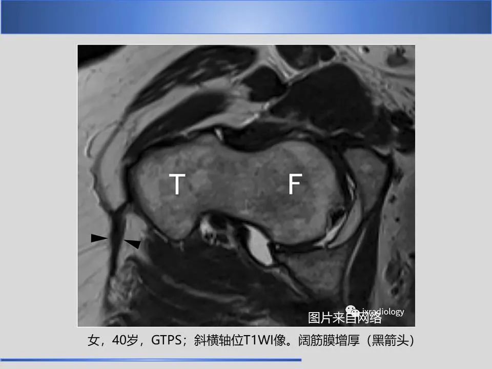 影像PPT - 【PPT】股骨大转子疼痛综合征MR特征-23