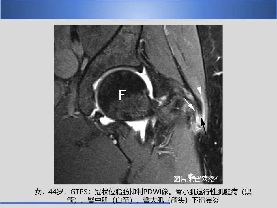 影像PPT - 【PPT】股骨大转子疼痛综合征MR特征-24
