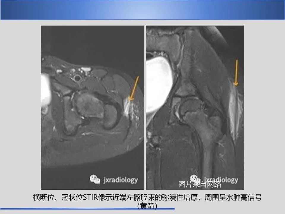 影像PPT - 【PPT】股骨大转子疼痛综合征MR特征-25