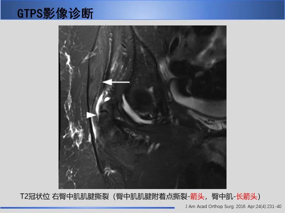 影像PPT - 【PPT】股骨大转子疼痛综合征MR特征-26