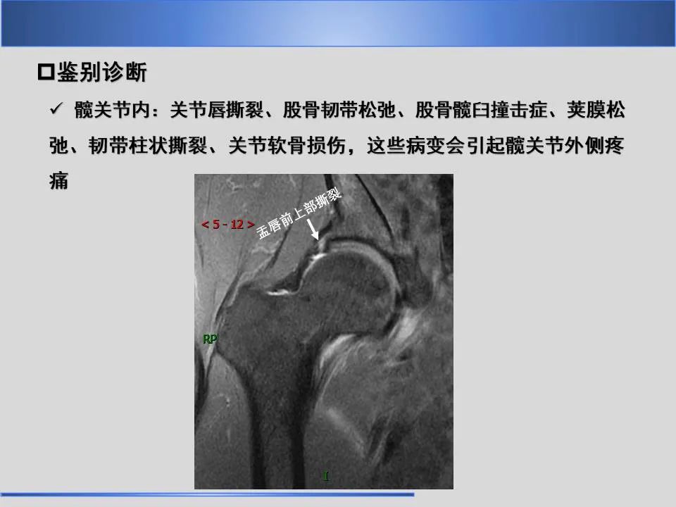 影像PPT - 【PPT】股骨大转子疼痛综合征MR特征-28