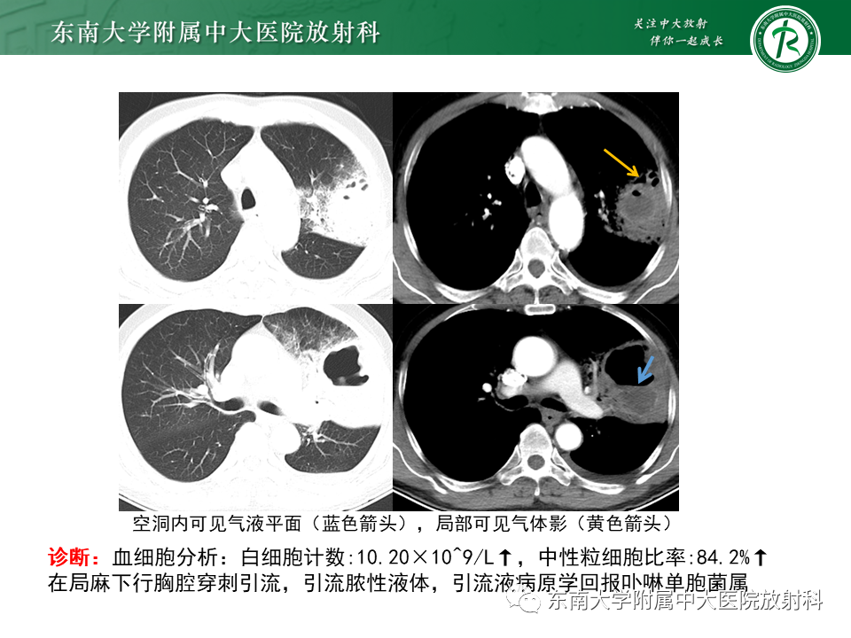 影像PPT - 【病例】肺脓肿1例CT影像-2