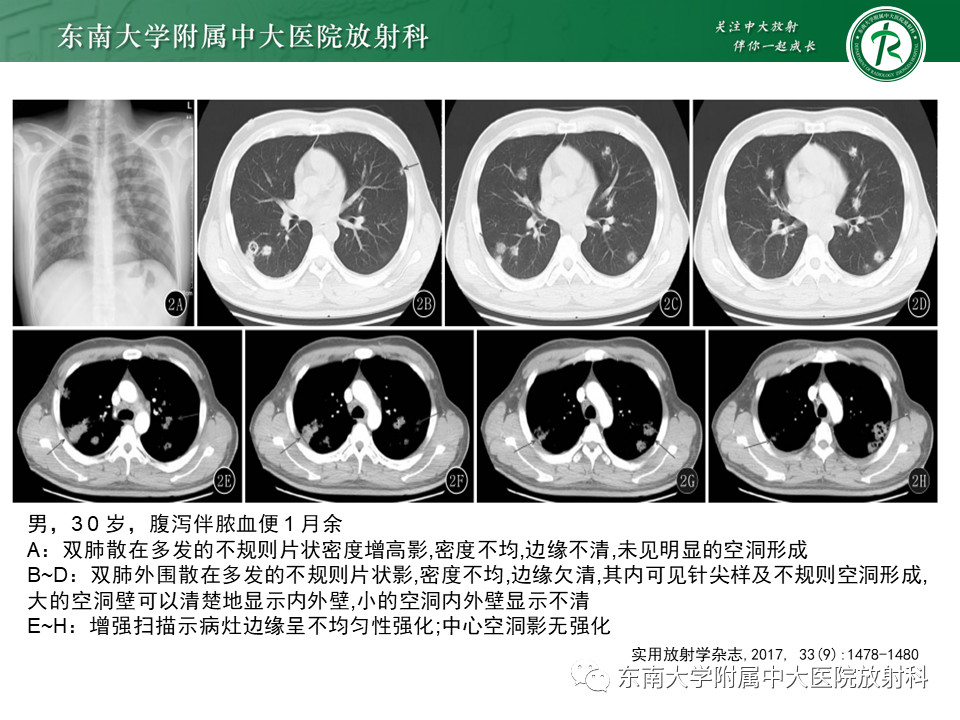 影像PPT - 【病例】肺脓肿1例CT影像-10