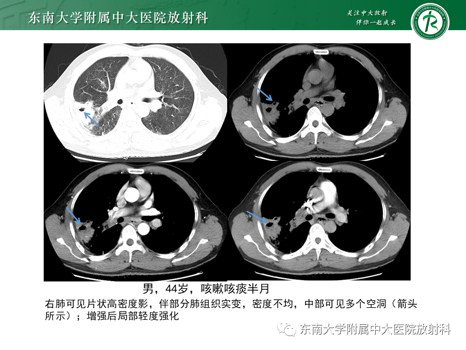 影像PPT - 【病例】肺脓肿1例CT影像-15