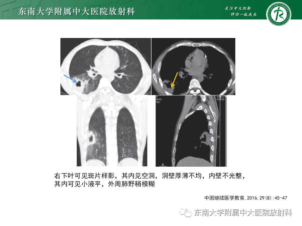 影像PPT - 【病例】肺脓肿1例CT影像-16