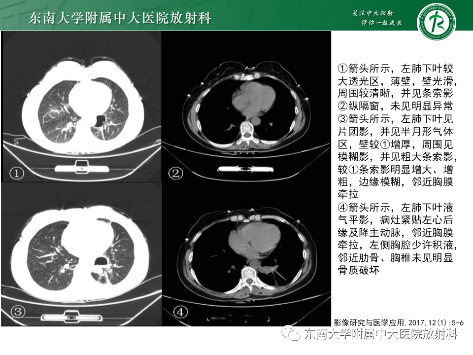影像PPT - 【病例】肺脓肿1例CT影像-20