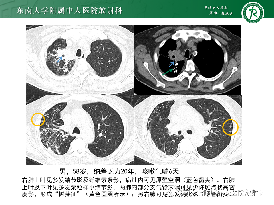 影像PPT - 【病例】肺脓肿1例CT影像-23