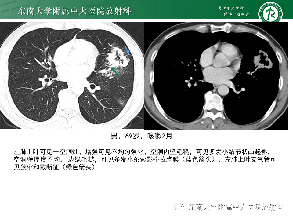 影像PPT - 【病例】肺脓肿1例CT影像-26