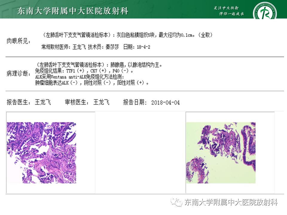 影像PPT - 【病例】肺脓肿1例CT影像-27