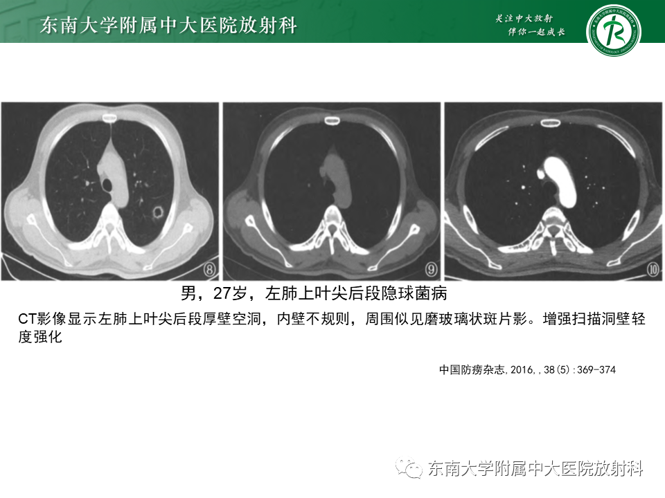 影像PPT - 【病例】肺脓肿1例CT影像-30