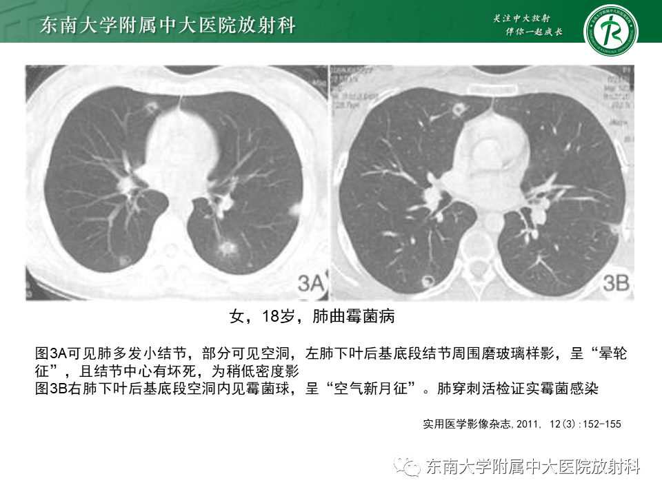 影像PPT - 【病例】肺脓肿1例CT影像-31