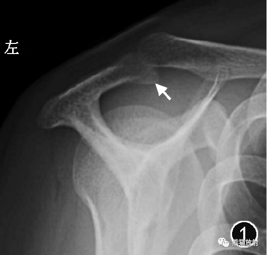 影像PPT - 肩峰下撞击综合征的临床及影像表现-1 影像PPT - 肩峰下撞击综合征的临床及影像表现-1