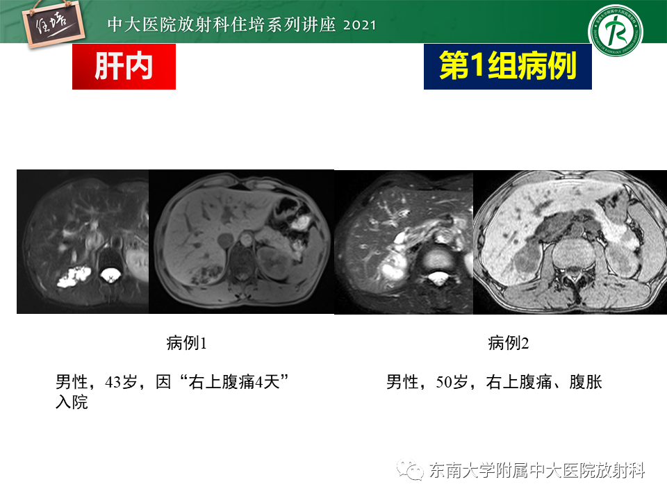 影像PPT - 【PPT】认识胆道系统影像常见漏诊、误诊病变-3