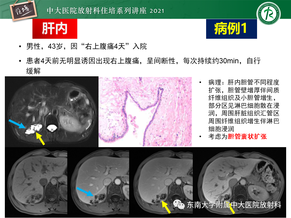 影像PPT - 【PPT】认识胆道系统影像常见漏诊、误诊病变-4