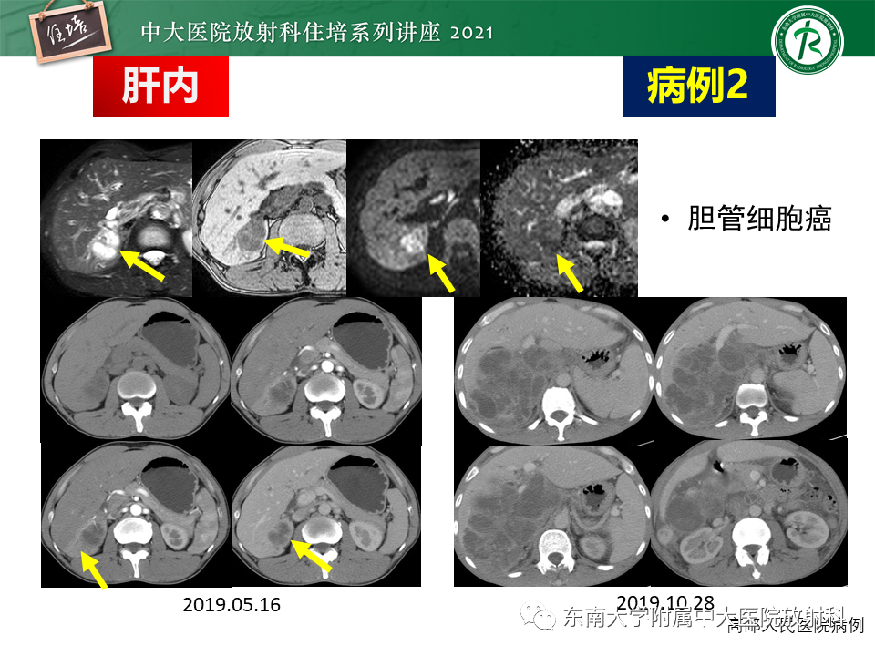 影像PPT - 【PPT】认识胆道系统影像常见漏诊、误诊病变-5