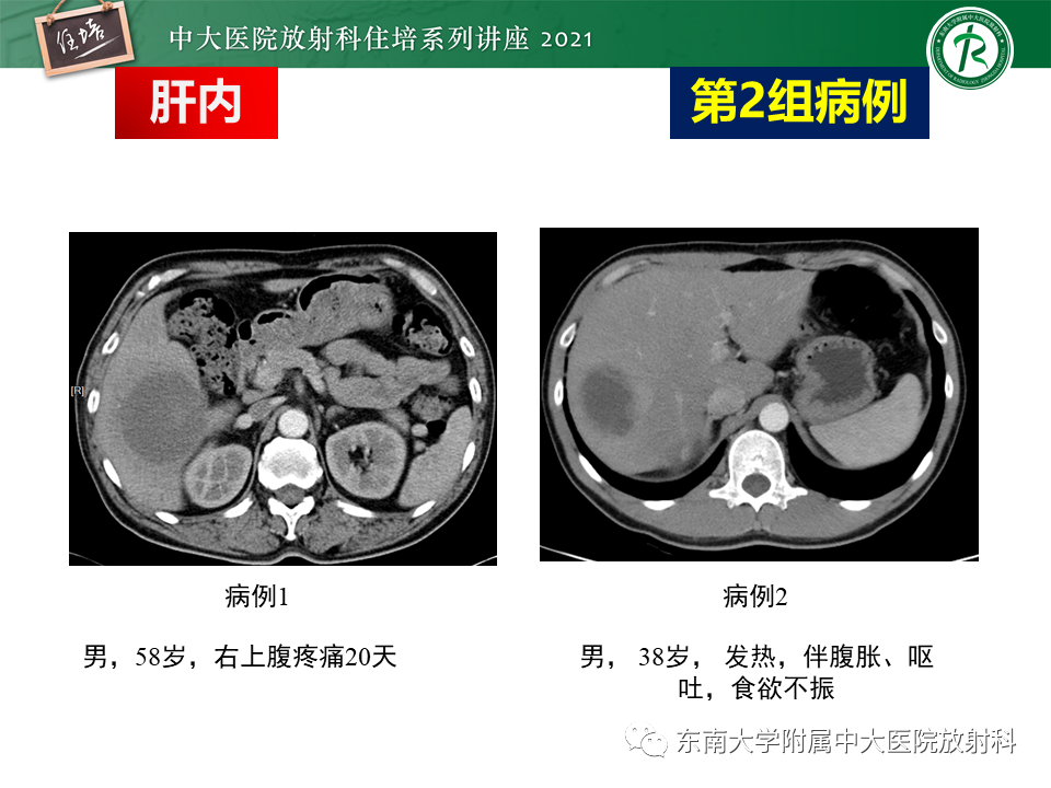 影像PPT - 【PPT】认识胆道系统影像常见漏诊、误诊病变-6