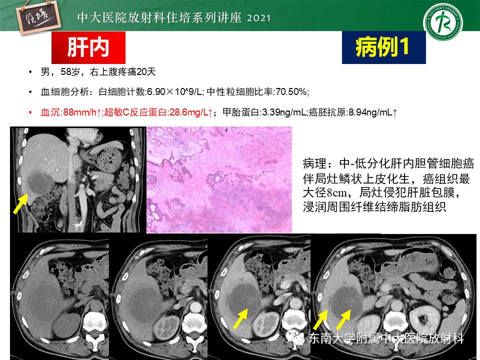 影像PPT - 【PPT】认识胆道系统影像常见漏诊、误诊病变-7