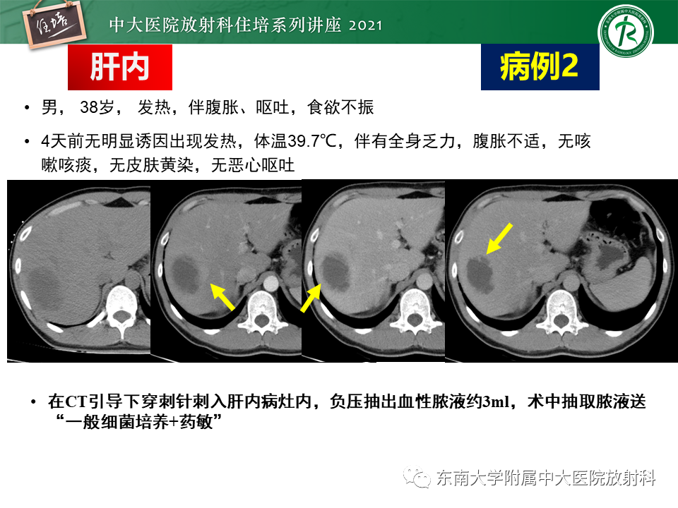 影像PPT - 【PPT】认识胆道系统影像常见漏诊、误诊病变-8