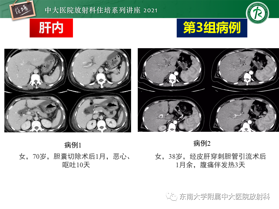 影像PPT - 【PPT】认识胆道系统影像常见漏诊、误诊病变-13