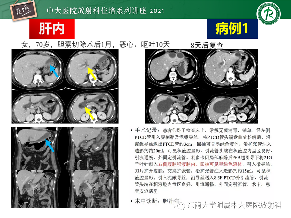 影像PPT - 【PPT】认识胆道系统影像常见漏诊、误诊病变-14