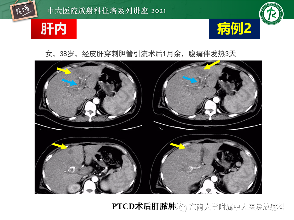 影像PPT - 【PPT】认识胆道系统影像常见漏诊、误诊病变-15